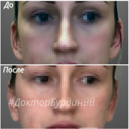 Отопластика при лопоухости через 1 месяц