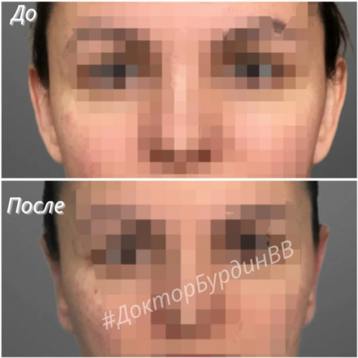 Отопластика при врожденной лопоухости: результат через 10 дней