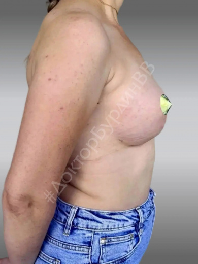 Увеличение груди с мастопексией после беременности и грудного вскармливания