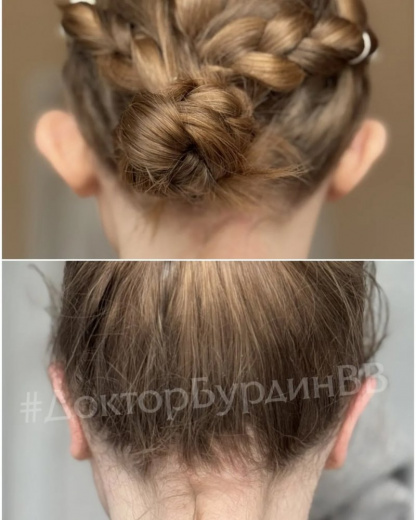Отопластика у ребёнка при асимметричной лопоухости: результат через 1 месяц