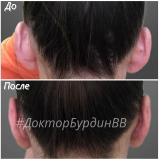 Отопластика при лопоухости через 1 месяц